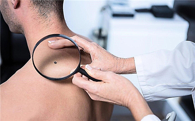 Skin cancer - types, symptoms, causes, description and video
