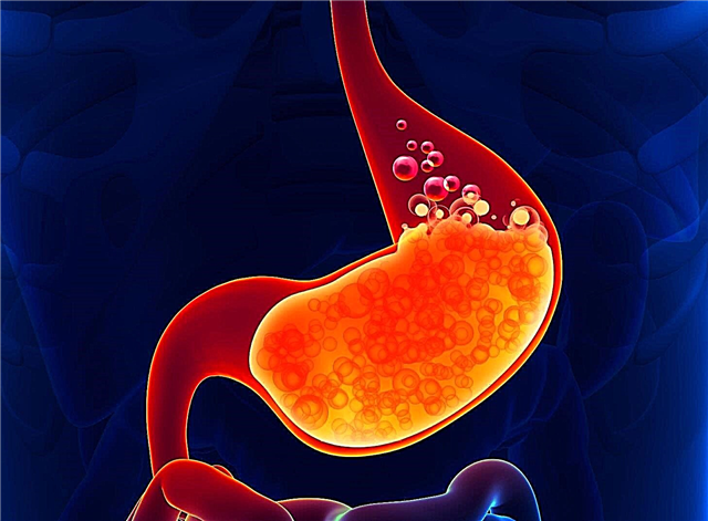 Pourquoi les brûlures d'estomac se produisent-elles? Raisons de quoi, photos et vidéos