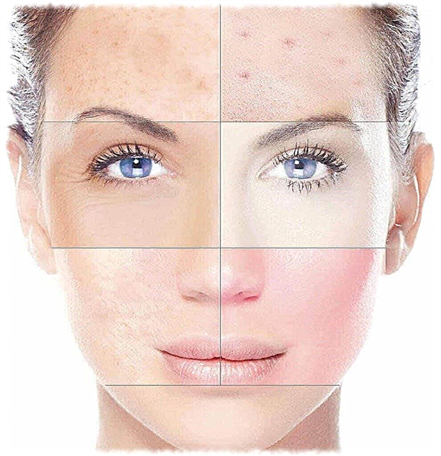 Pourquoi la pigmentation de la peau se produit-elle et comment la guérir?